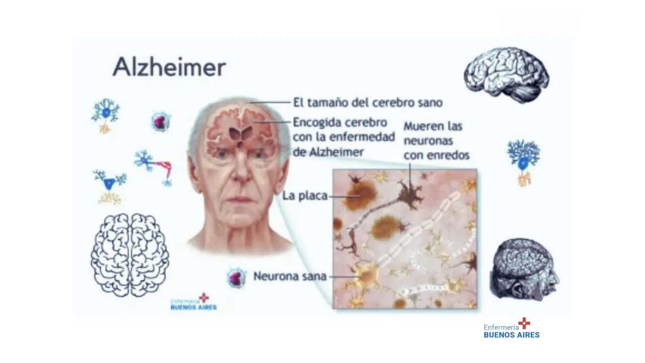 Alzheimer