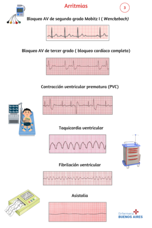 Interpretación de un Electrocardiograma