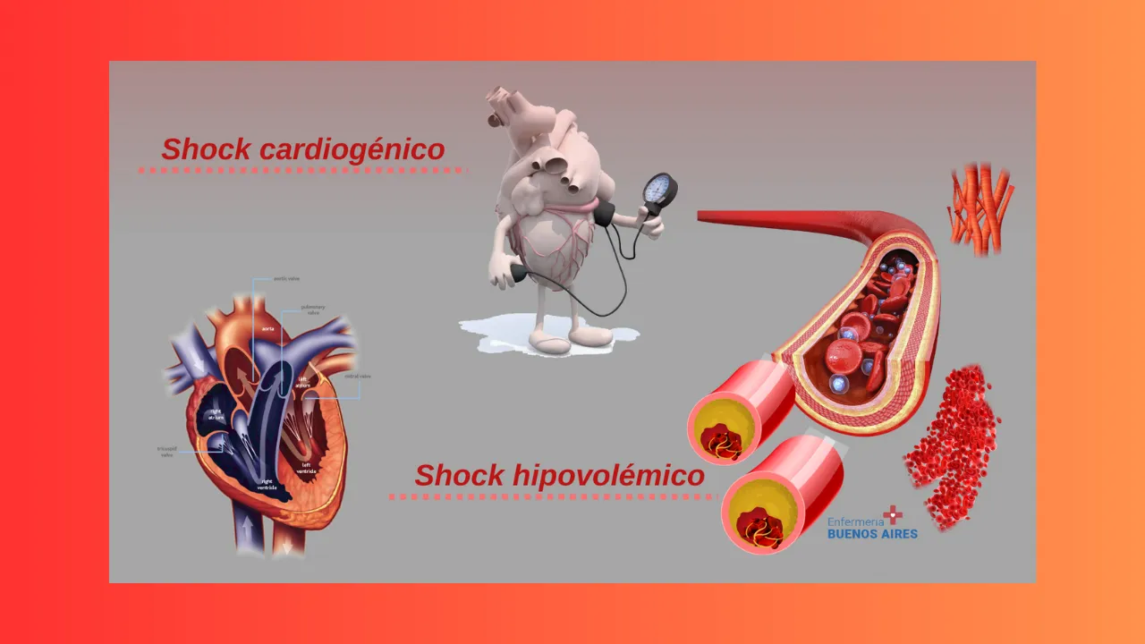 Shock cardiogénico y shock hipovolémico