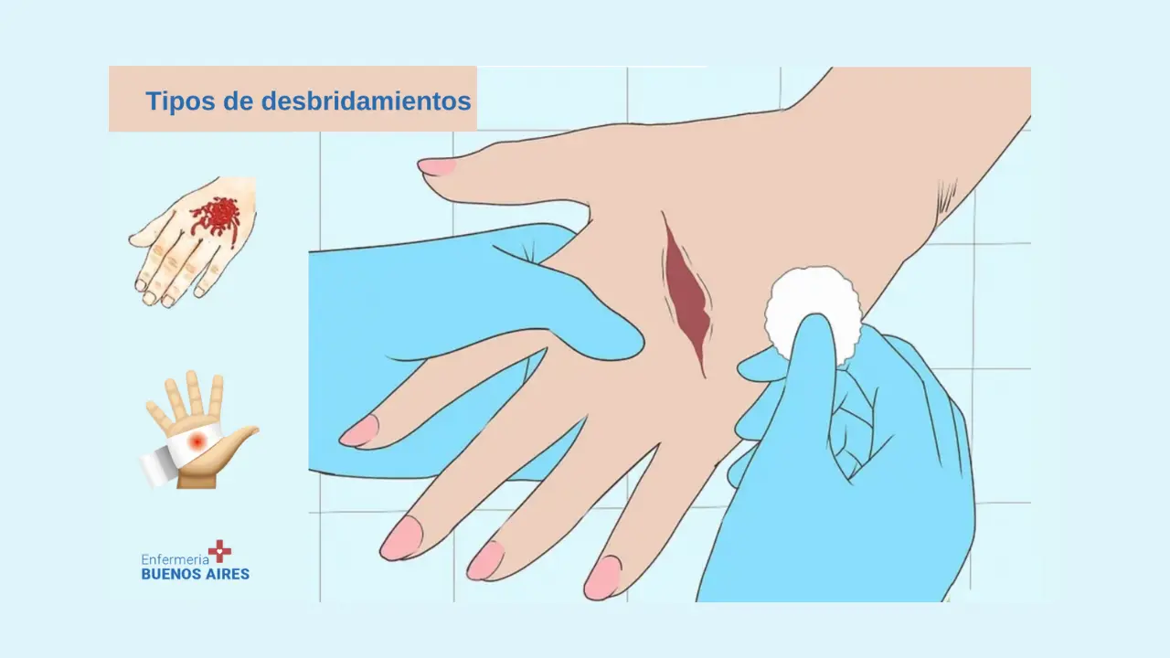 Tipos de desbridamientos