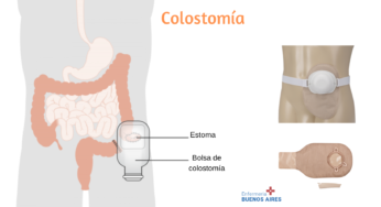 Colostomía temporal – Tipos de colostomías