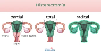 Histerectomía total – PAE