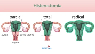 Histerectomía total - PAE
