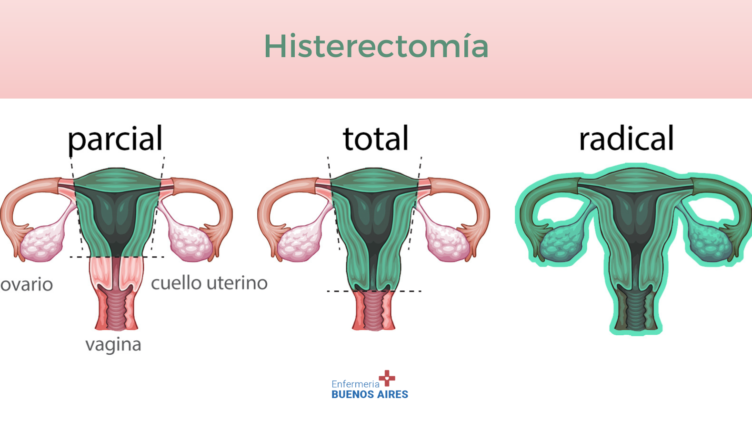 Histerectomía total - PAE