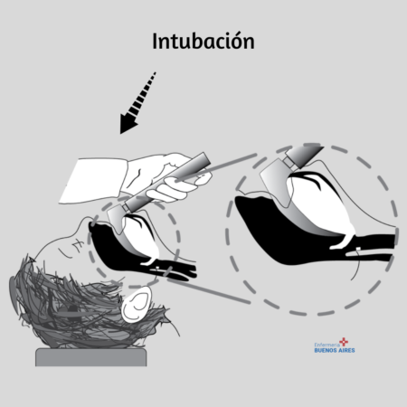 Intubación