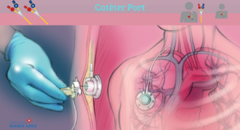 Catéter port – “Implante subcutáneo”