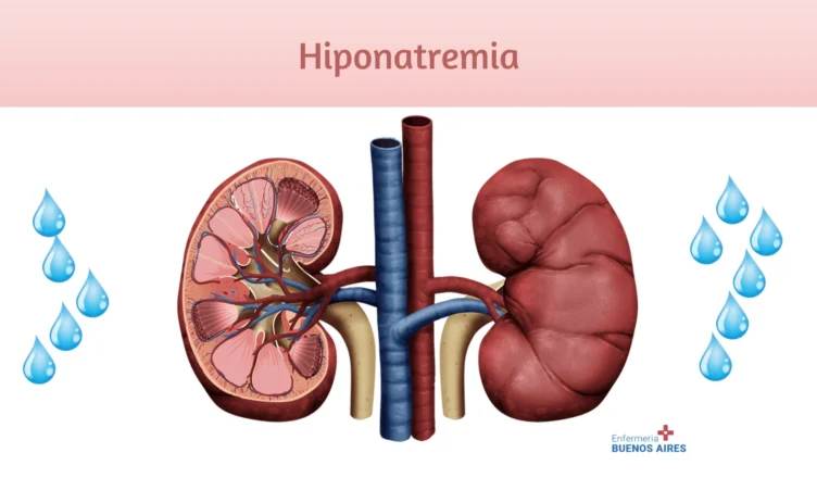 Hiponatremia