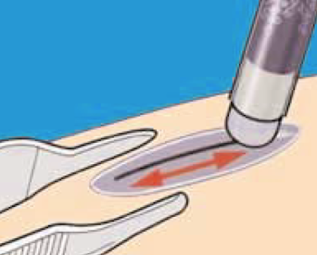 ¿Cuáles son los 7 tipos de sutura?