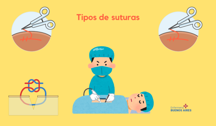 medico_clasico - TIPOS DE SUTURAS Las suturas es cualquier tipo de material  utilizado para ayudar a la cicatrización de una herida, mediante la  aproximación de los bordes con el objetivo de mantenerlos