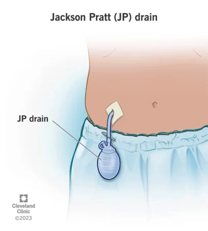 Drenaje Jackson-Pratt