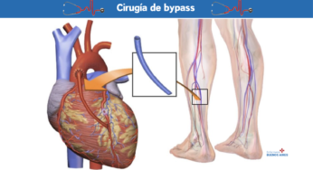 Solución efectiva: cirugía de bypass para la salud cardiovascular