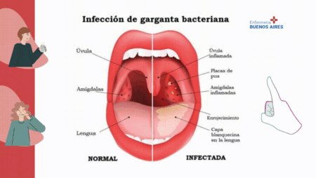 Antibiótico para la garganta