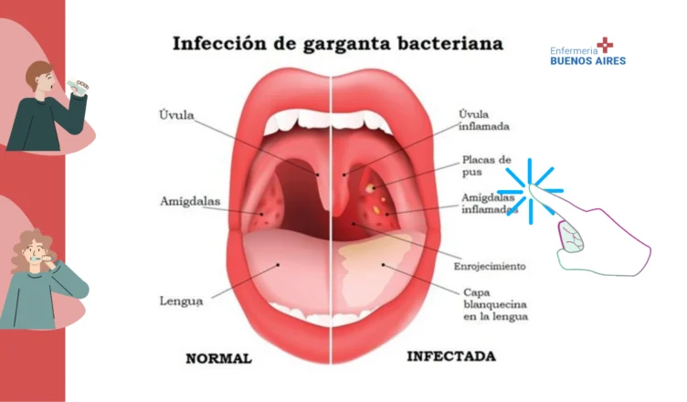 Antibiótico para la garganta