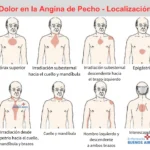 Tipos de Angina de Pecho