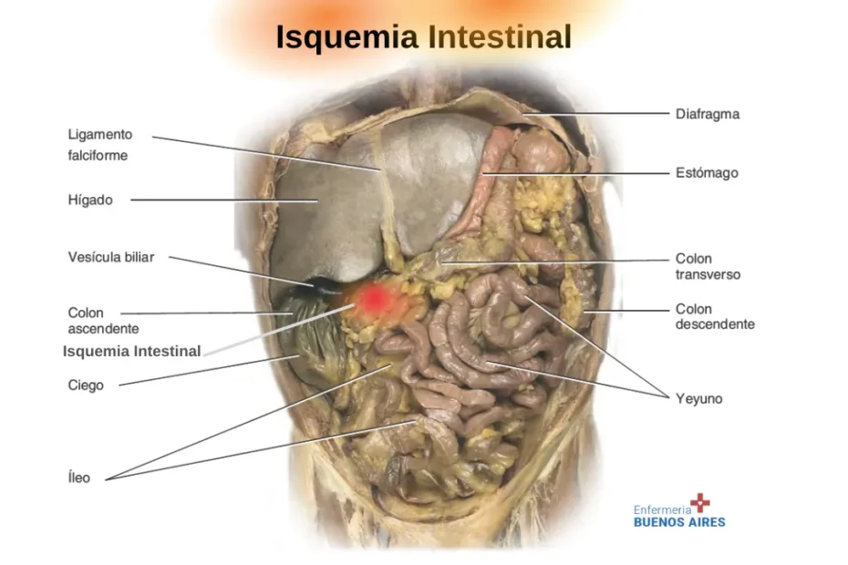 Isquemia Intestinal