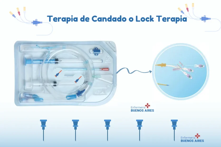 Terapia de Candado o Lock Terapia