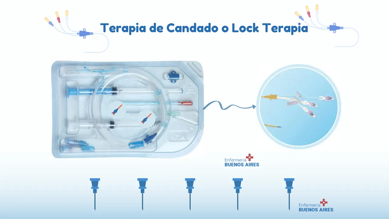 Terapia de Candado o Lock Terapia