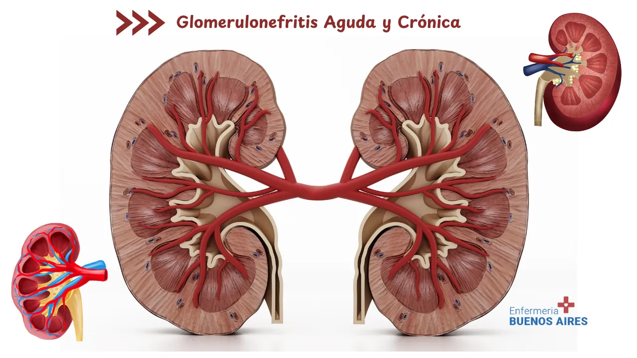 Glomerulonefritis Aguda y Crónica